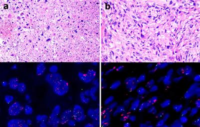 Anti-PD-1 Immunotherapy and Bee Venom for Relapsed and Refractory Liposarcoma: A Case Report